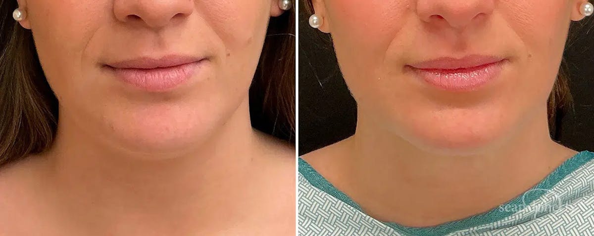 Liposuction and Fat Transfer Before & After Gallery - Patient 538688 - Image 3