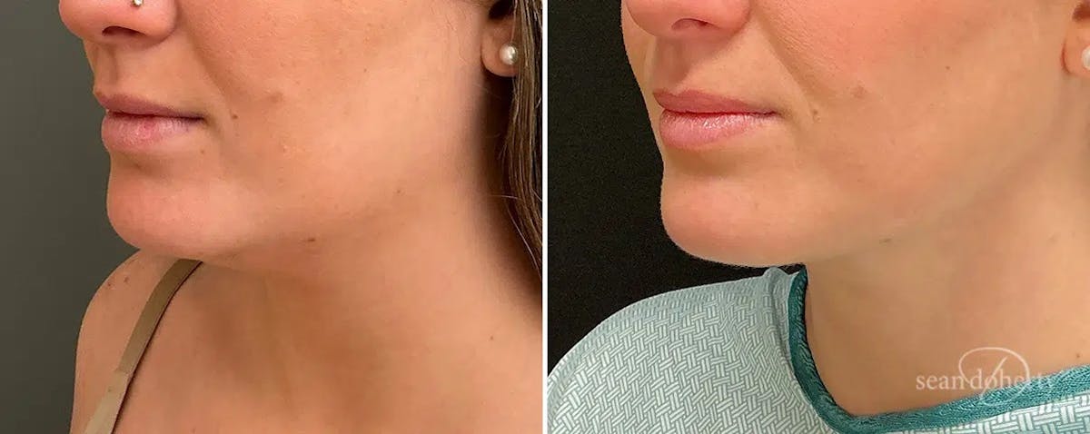 Liposuction and Fat Transfer Before & After Gallery - Patient 538688 - Image 2