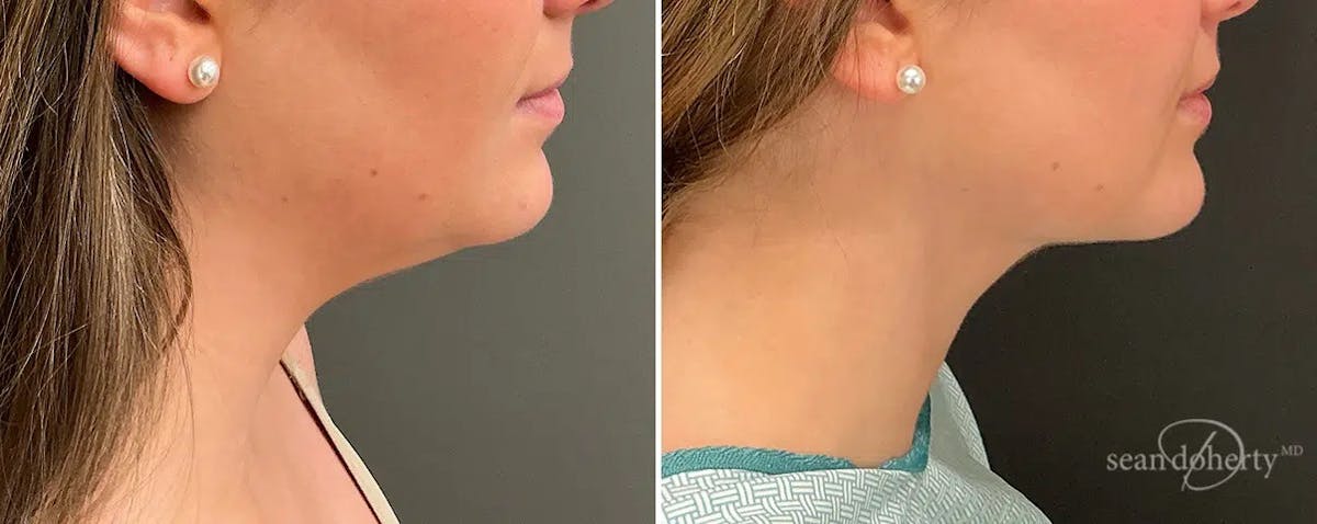 Liposuction and Fat Transfer Before & After Gallery - Patient 538688 - Image 1