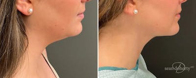 Liposuction and Fat Transfer Before & After Gallery - Patient 538688 - Image 1