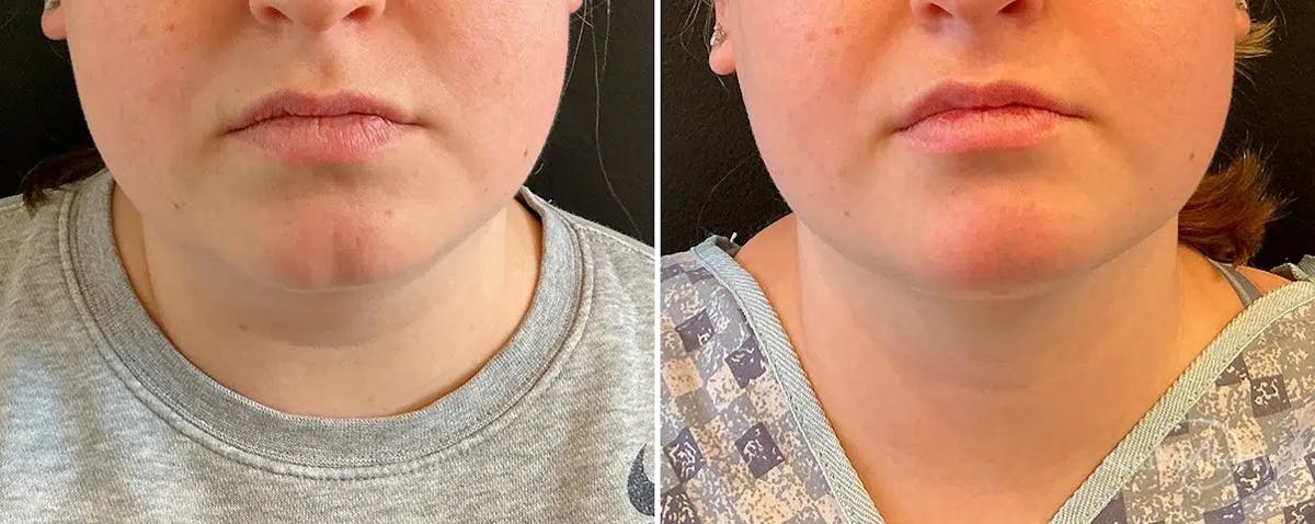 Liposuction and Fat Transfer Before & After Gallery - Patient 351809 - Image 3