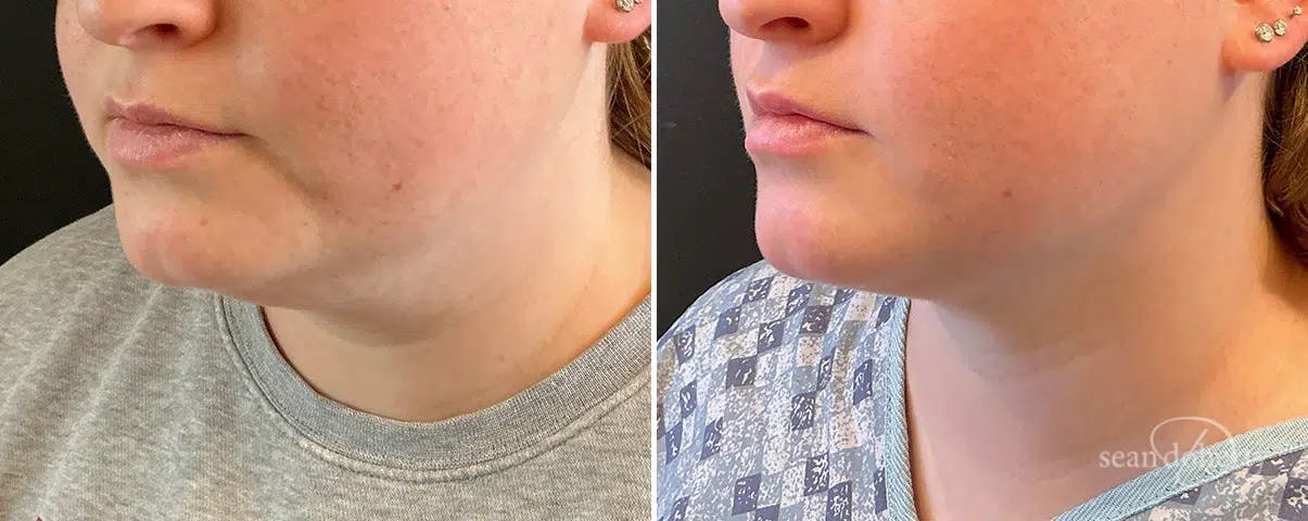 Liposuction and Fat Transfer Before & After Gallery - Patient 351809 - Image 2
