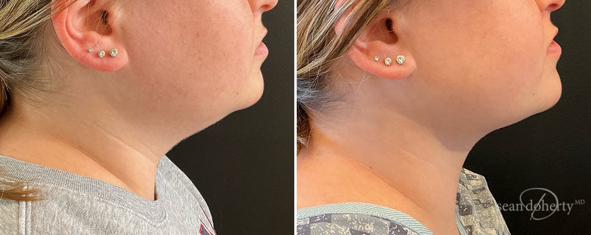 Liposuction and Fat Transfer Before & After Gallery - Patient 351809 - Image 1