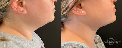 Liposuction and Fat Transfer Before & After Gallery - Patient 351809 - Image 1