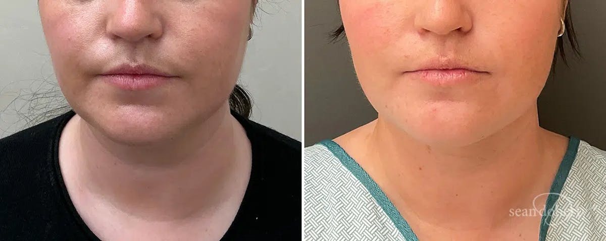 Liposuction and Fat Transfer Before & After Gallery - Patient 140733 - Image 3