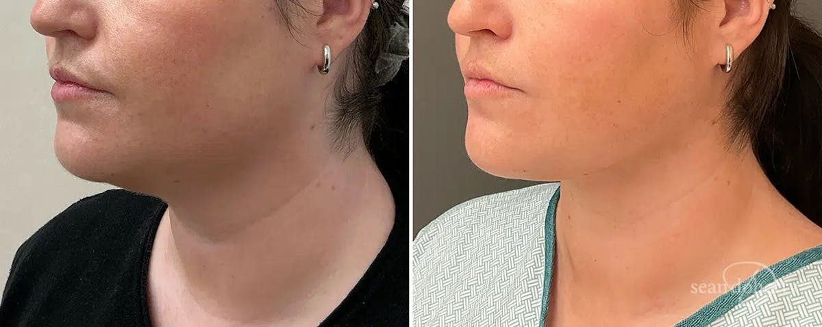 Liposuction and Fat Transfer Before & After Gallery - Patient 140733 - Image 2