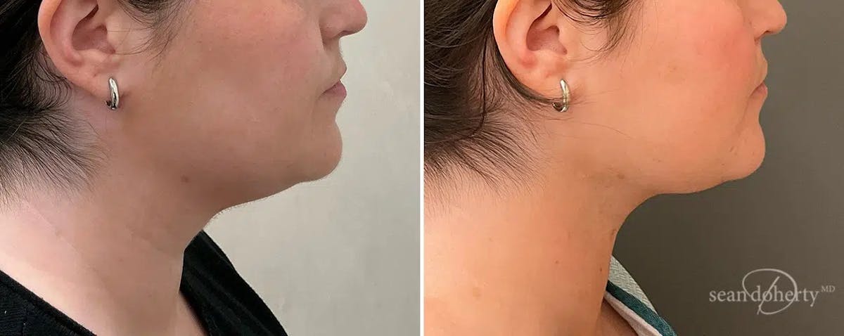 Liposuction and Fat Transfer Before & After Gallery - Patient 140733 - Image 1