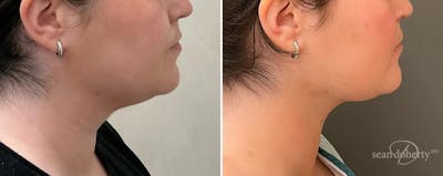Liposuction and Fat Transfer Before & After Gallery - Patient 140733 - Image 1