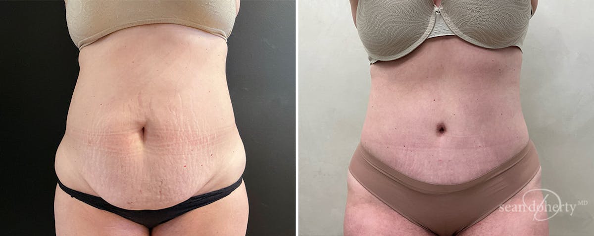 Abdominoplasty (Tummy Tuck) Before & After Gallery - Patient 745167 - Image 1