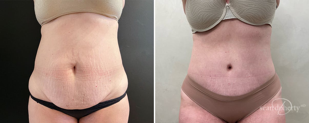 Abdominoplasty (Tummy Tuck) Before & After Gallery - Patient 745167 - Image 1