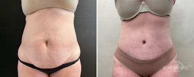 Abdominoplasty (Tummy Tuck) Before & After Gallery - Patient 745167 - Image 1