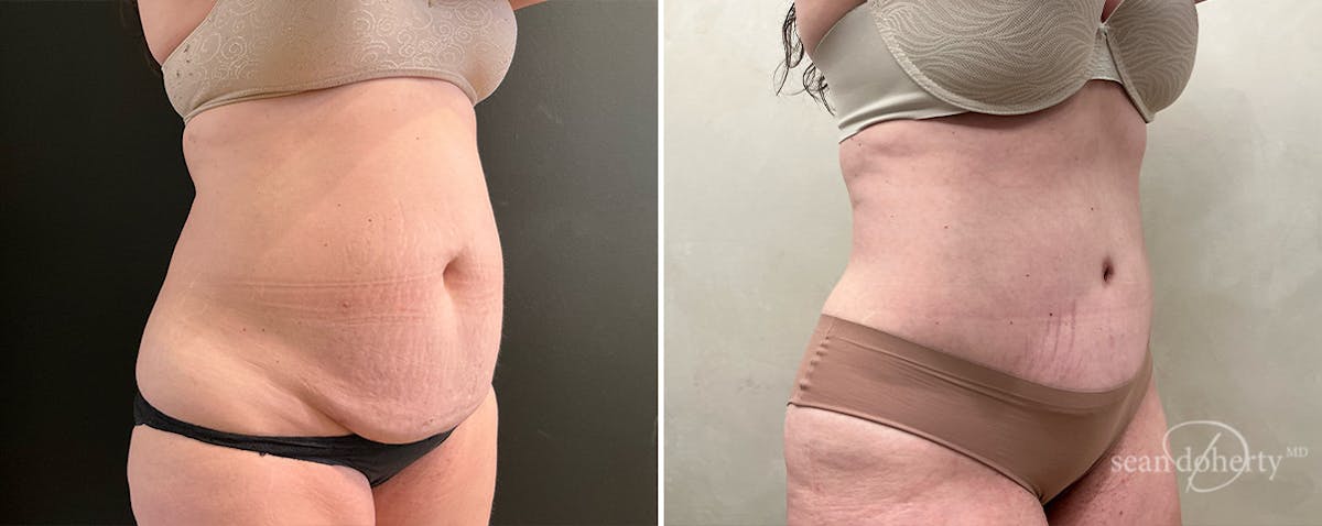 Abdominoplasty (Tummy Tuck) Before & After Gallery - Patient 745167 - Image 2