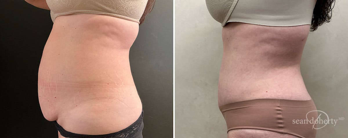 Abdominoplasty (Tummy Tuck) Before & After Gallery - Patient 745167 - Image 3