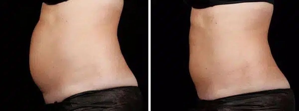 Coolsculpting Before & After Gallery - Patient 167465 - Image 1