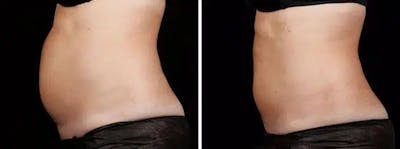 Coolsculpting Before & After Gallery - Patient 167465 - Image 1