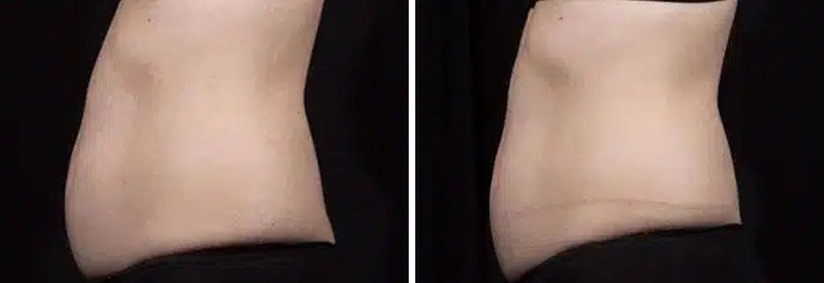 Coolsculpting Before & After Gallery - Patient 261378 - Image 1