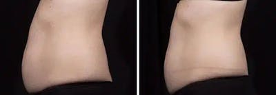 Coolsculpting Before & After Gallery - Patient 261378 - Image 1