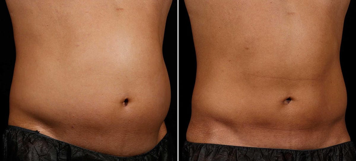 Coolsculpting Before & After Gallery - Patient 139579 - Image 1