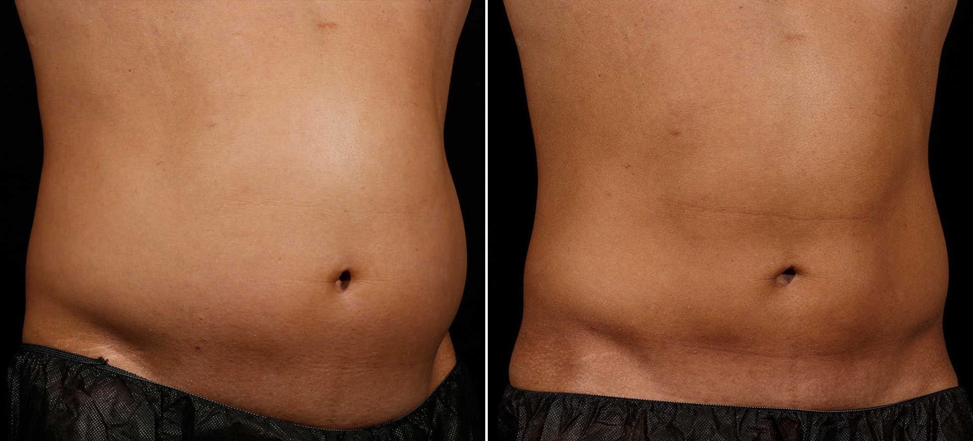 Coolsculpting Before & After Gallery - Patient 139579 - Image 1