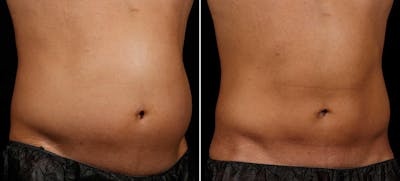 Coolsculpting Before & After Gallery - Patient 139579 - Image 1