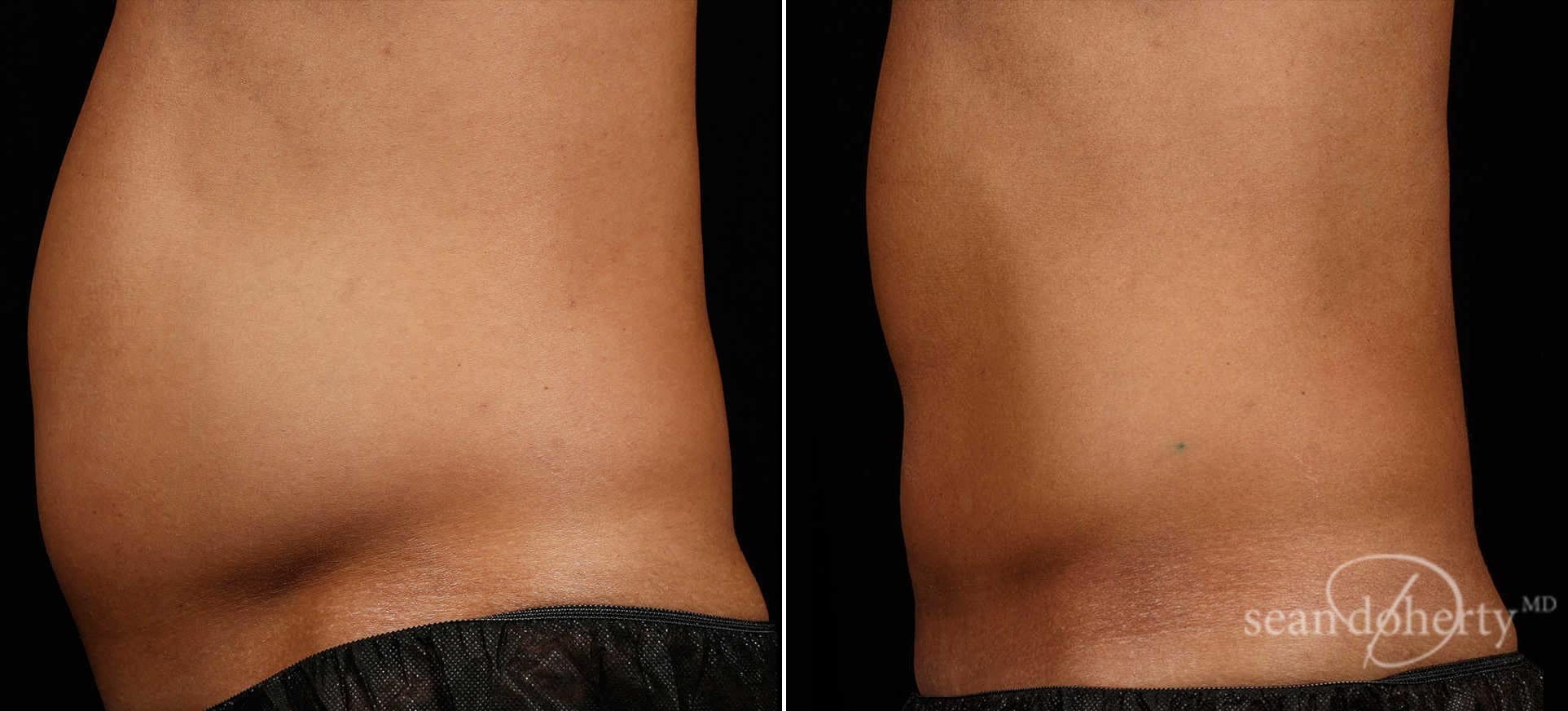 Coolsculpting Before & After Gallery - Patient 139579 - Image 3