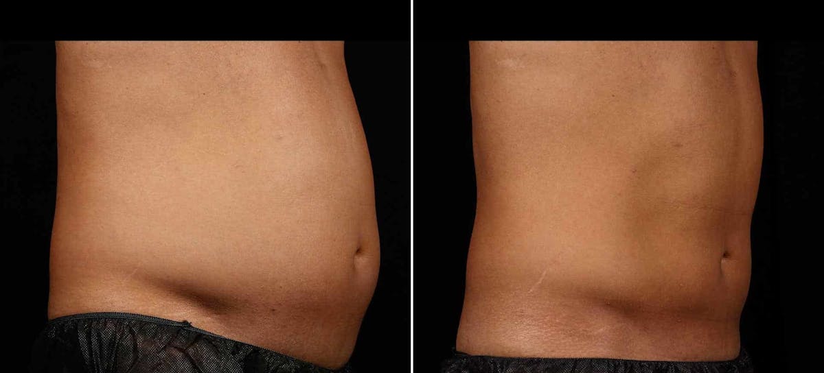 Coolsculpting Before & After Gallery - Patient 139579 - Image 2