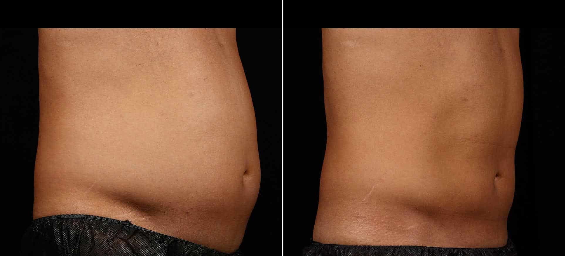 Coolsculpting Before & After Gallery - Patient 139579 - Image 2