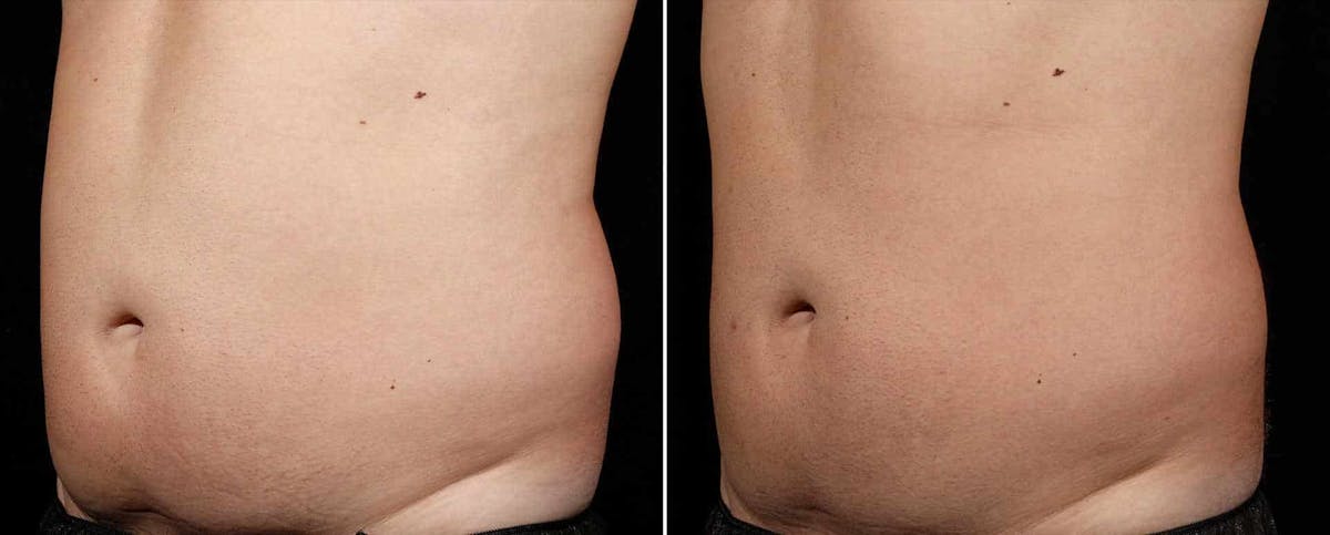 Coolsculpting Before & After Gallery - Patient 222280 - Image 1