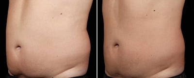 Coolsculpting Before & After Gallery - Patient 222280 - Image 1