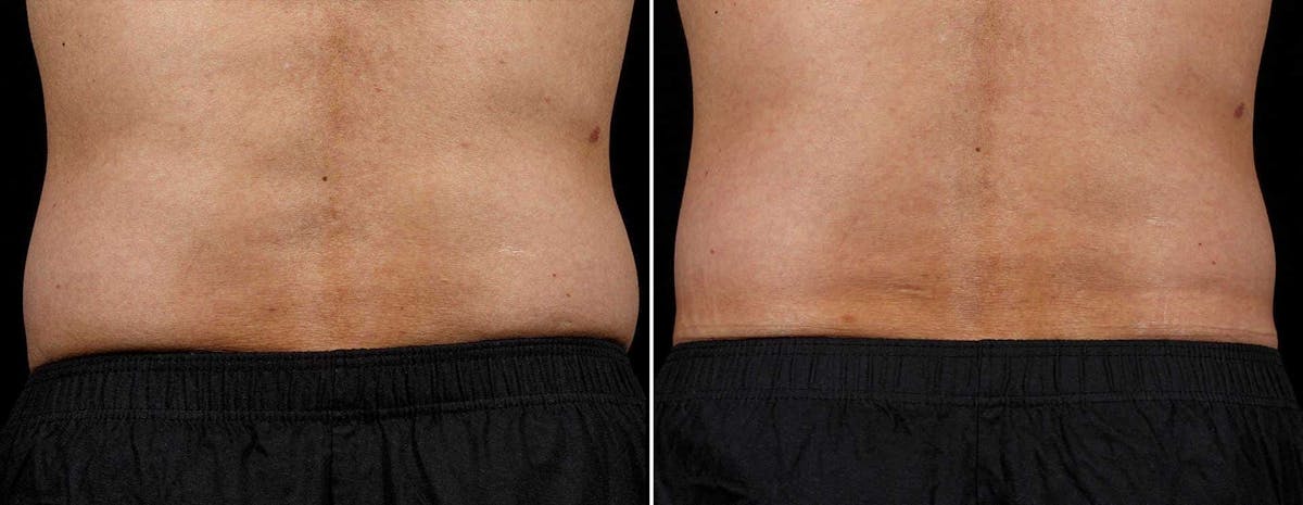 Coolsculpting Before & After Gallery - Patient 342370 - Image 1