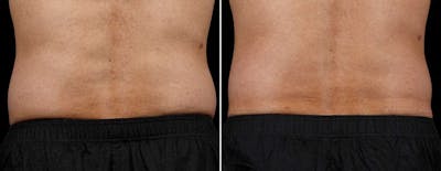 Coolsculpting Before & After Gallery - Patient 342370 - Image 1