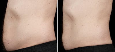 Coolsculpting Before & After Gallery - Patient 244496 - Image 1