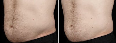 Coolsculpting Before & After Gallery - Patient 353843 - Image 1