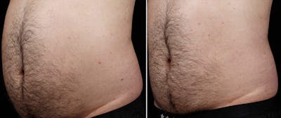 Coolsculpting Before & After Gallery - Patient 424924 - Image 1