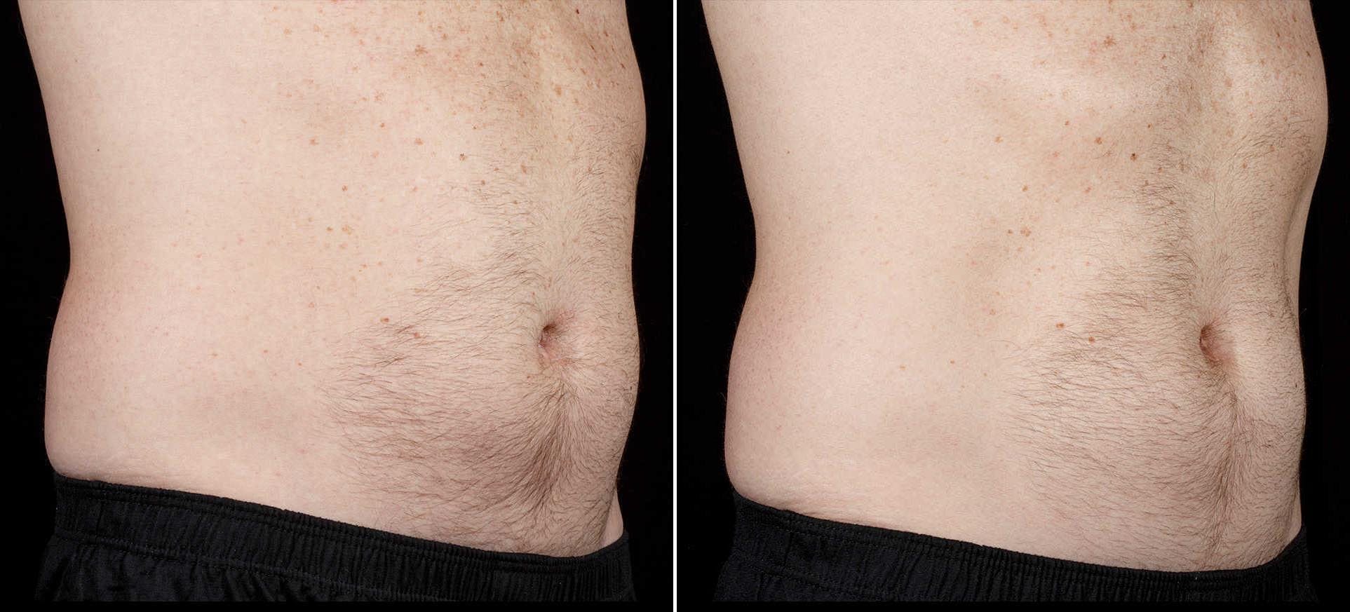 Coolsculpting Before & After Gallery - Patient 334201 - Image 1