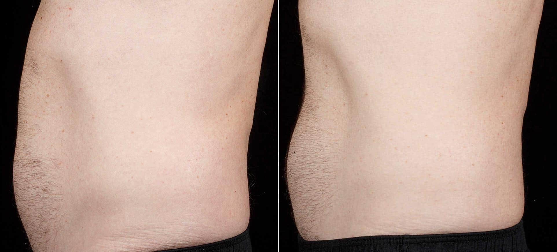 Coolsculpting Before & After Gallery - Patient 334201 - Image 2