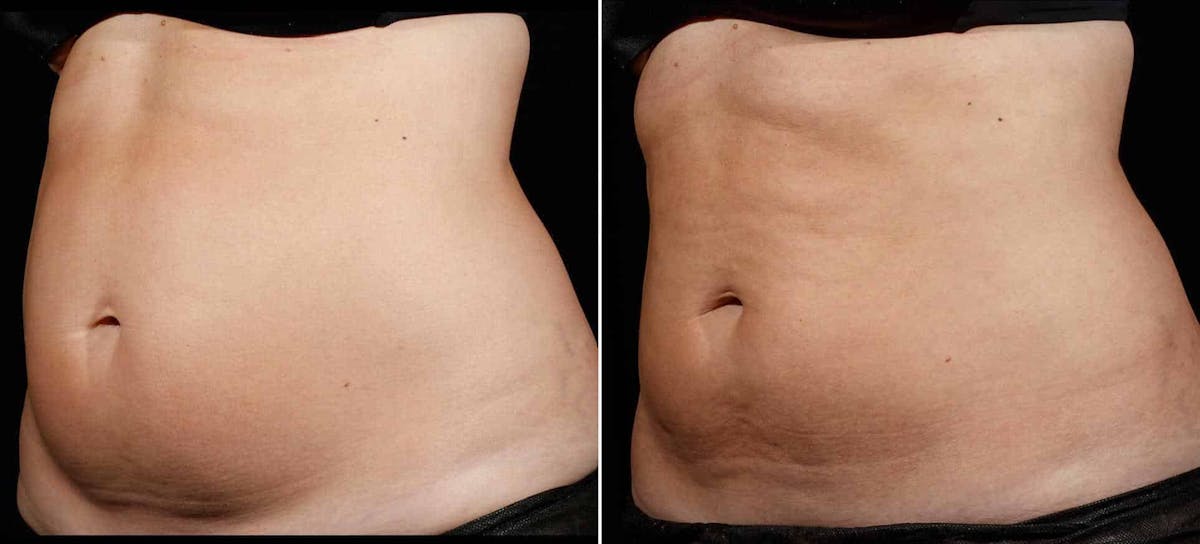 Coolsculpting Before & After Gallery - Patient 128976 - Image 1
