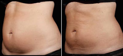Coolsculpting Before & After Gallery - Patient 128976 - Image 1