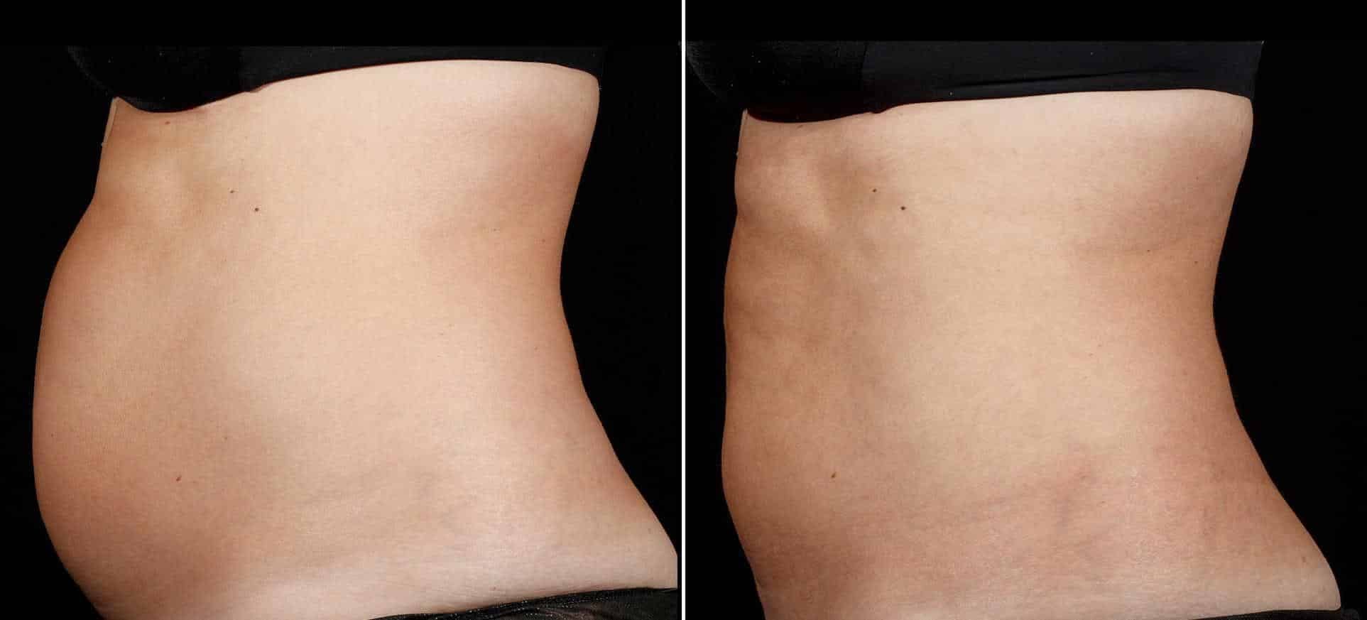 Coolsculpting Before & After Gallery - Patient 128976 - Image 2