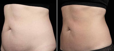 Coolsculpting Before & After Gallery - Patient 426398 - Image 1