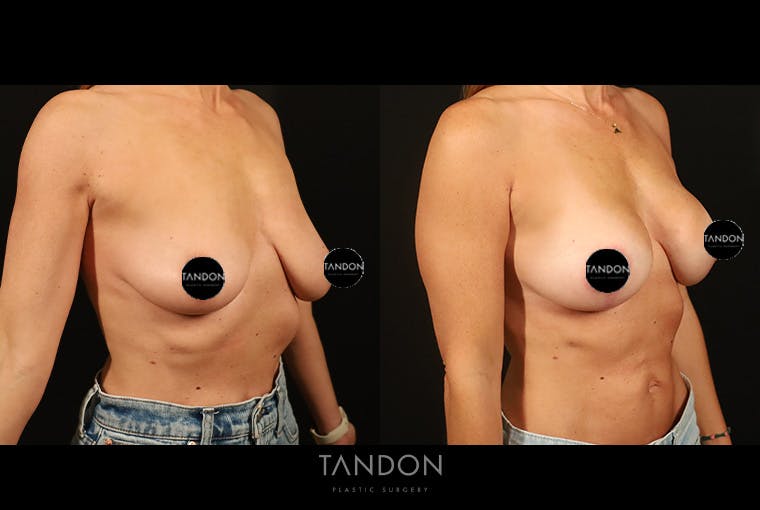 Breast Augmentation Before & After Gallery - Patient 125085 - Image 2