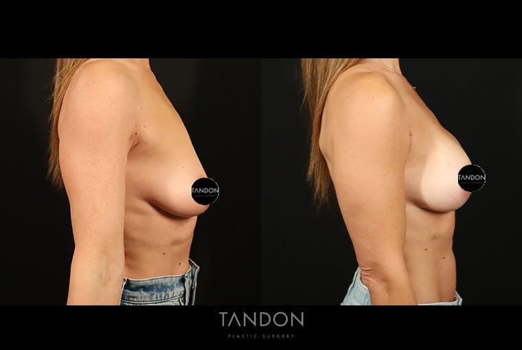 Breast Augmentation Before & After Gallery - Patient 125085 - Image 3