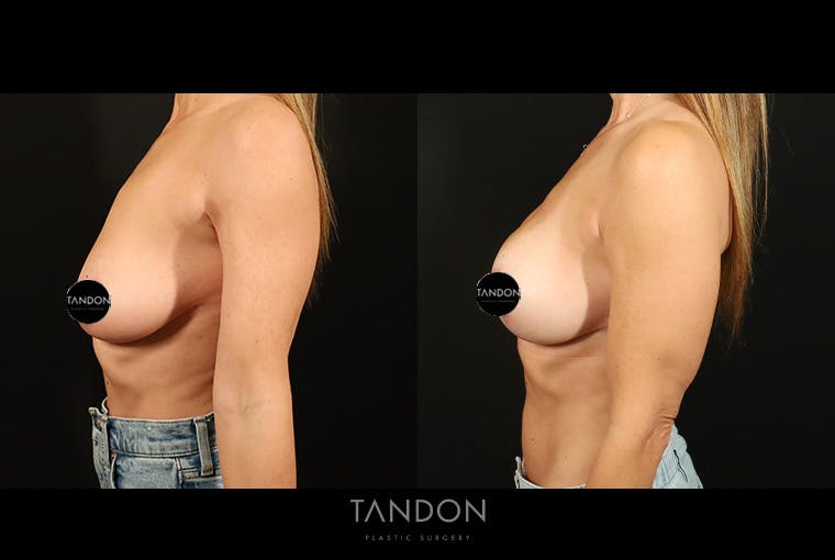 Breast Augmentation Before & After Gallery - Patient 125085 - Image 5