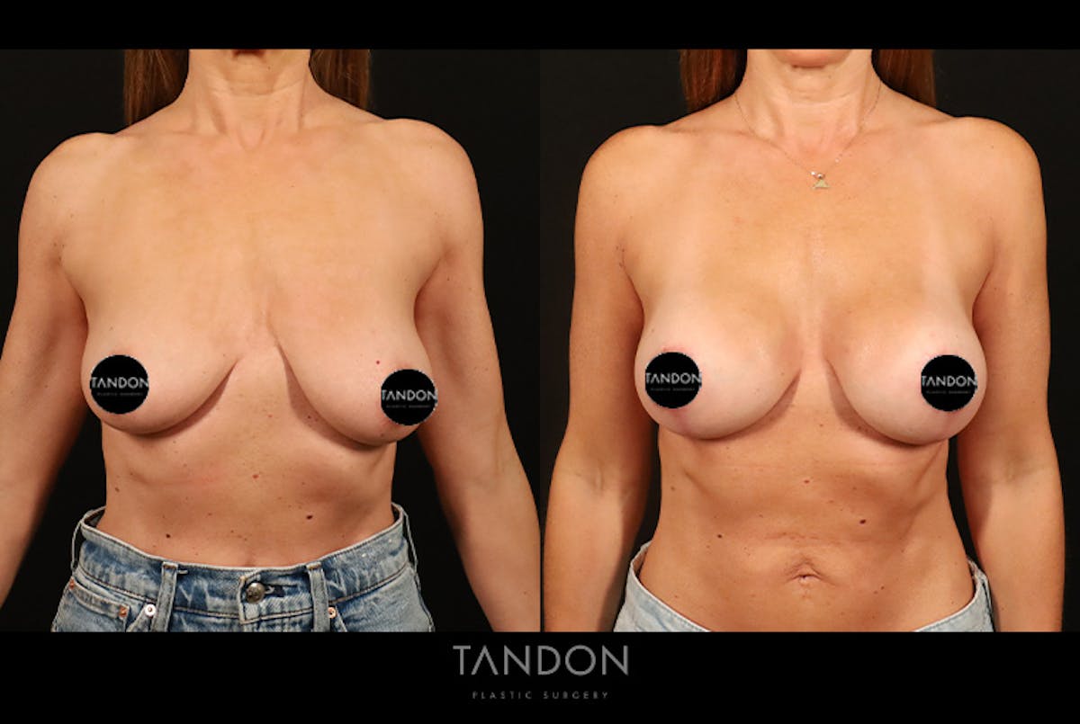 Breast Augmentation Before & After Gallery - Patient 125085 - Image 1