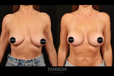 Breast Augmentation Before & After Gallery - Patient 125085 - Image 1
