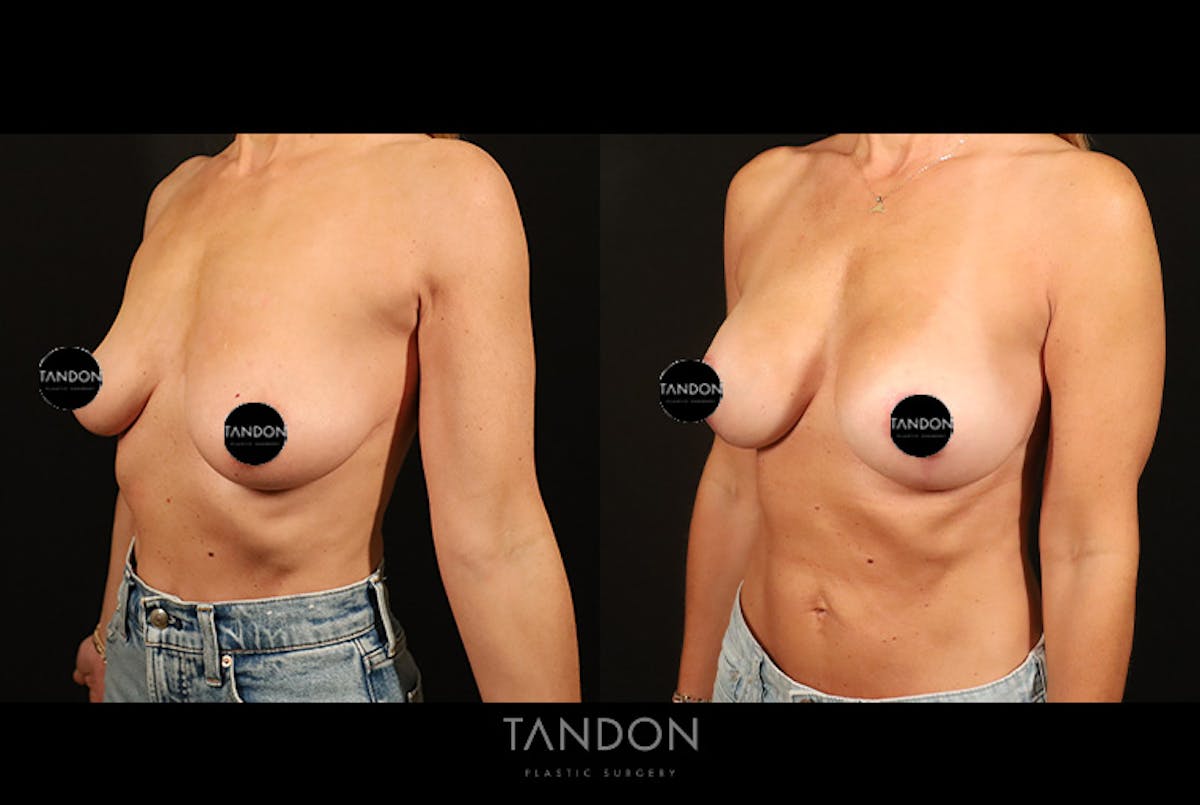 Breast Augmentation Before & After Gallery - Patient 125085 - Image 4