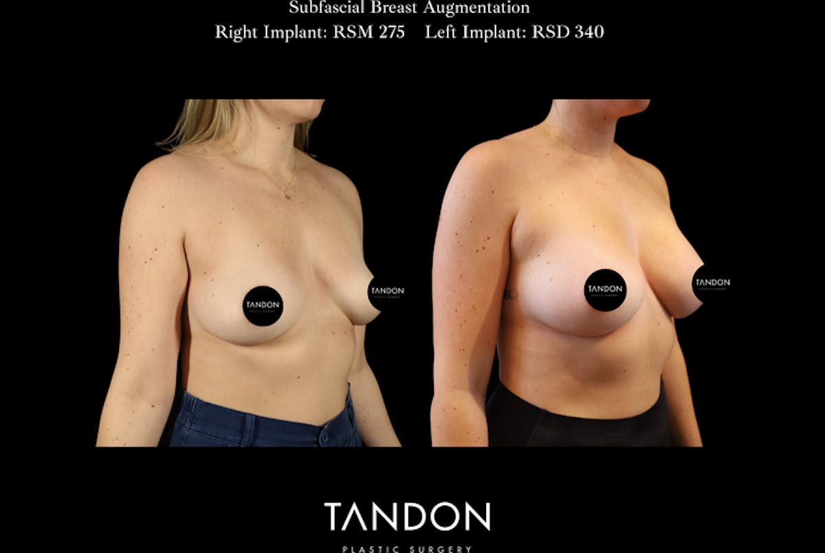 Breast Augmentation Before & After Gallery - Patient 288114 - Image 2