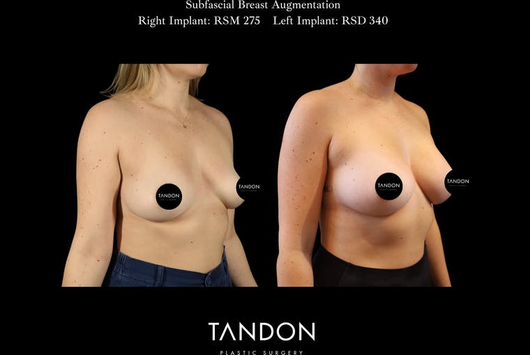 Breast Augmentation Before & After Gallery - Patient 288114 - Image 2