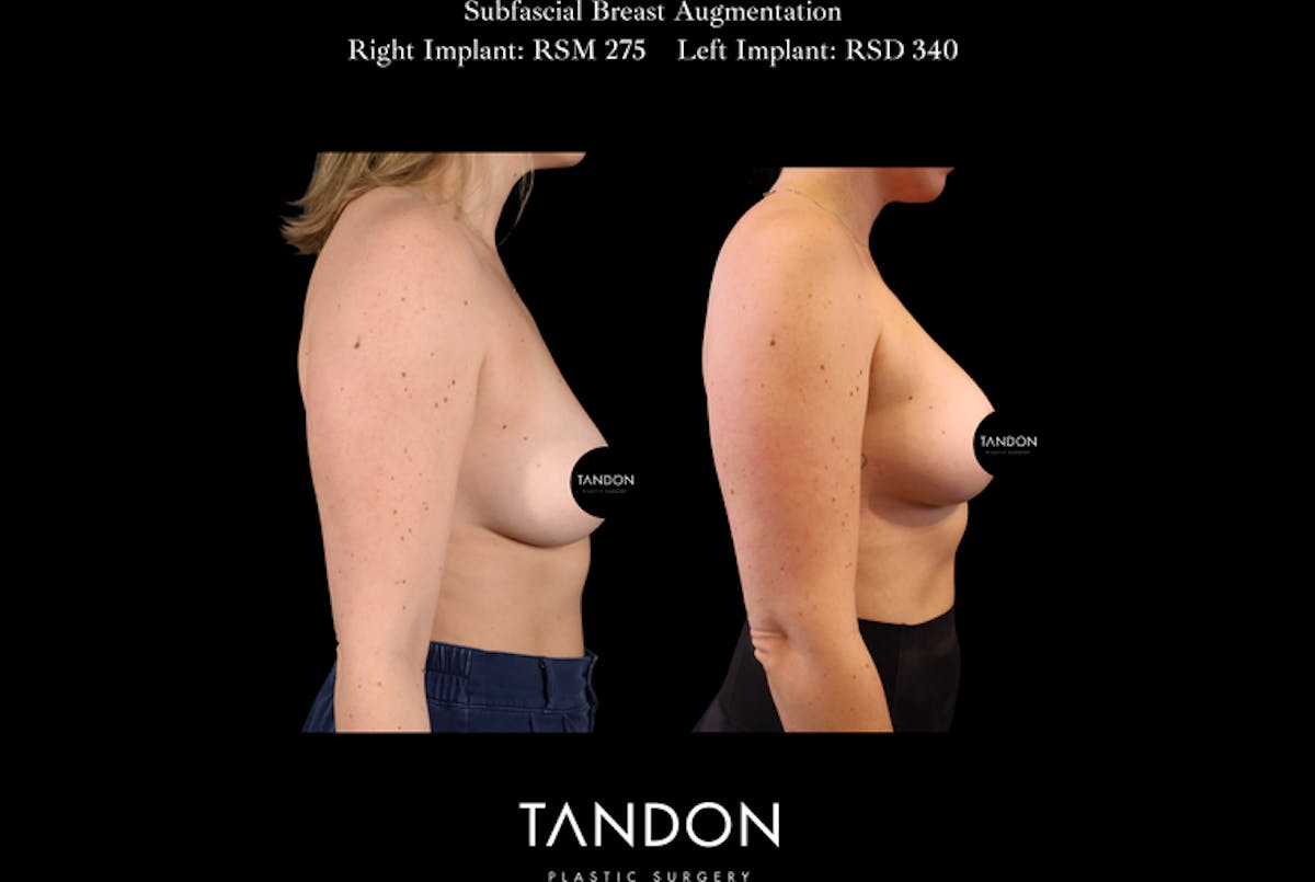 Breast Augmentation Before & After Gallery - Patient 288114 - Image 3
