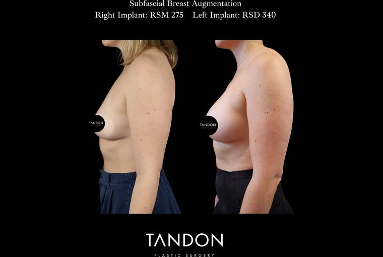 Breast Augmentation Before & After Gallery - Patient 288114 - Image 5